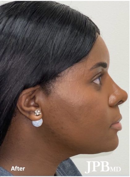 Facial Feminization Before & After Patient #2199