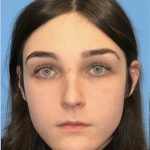 Facial Feminization Before & After Patient #2200