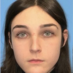 Facial Feminization Before & After Patient #2200