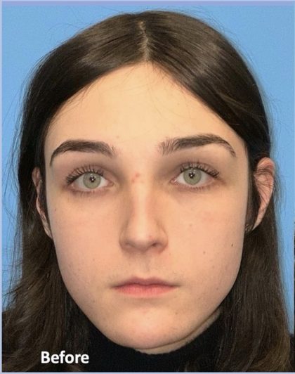 Facial Feminization Before & After Patient #2200