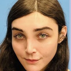 Facial Feminization Before & After Patient #2200