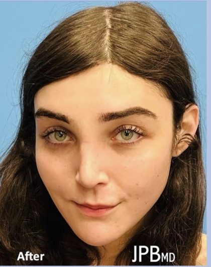 Facial Feminization Before & After Patient #2200