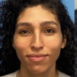 Facial Feminization Before & After Patient #2201