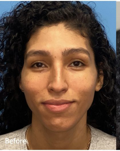 Facial Feminization Before & After Patient #2201