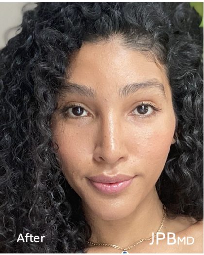 Facial Feminization Before & After Patient #2201