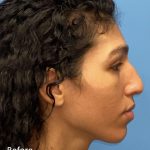Facial Feminization Before & After Patient #2201