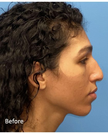 Facial Feminization Before & After Patient #2201