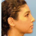 Facial Feminization Before & After Patient #2201