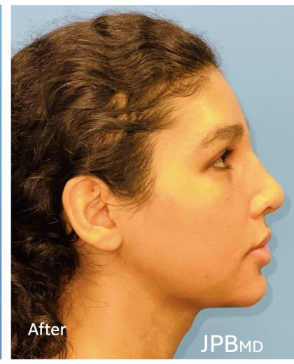 Facial Feminization Before & After Patient #2201