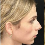 Facial Feminization Before & After Patient #2192