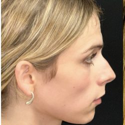 Facial Feminization Before & After Patient #2192