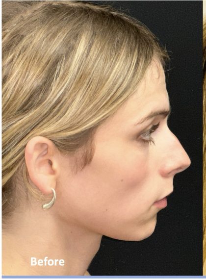 Facial Feminization Before & After Patient #2192