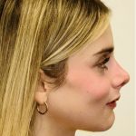 Facial Feminization Before & After Patient #2192