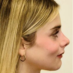 Facial Feminization Before & After Patient #2192
