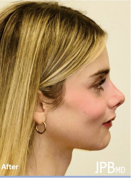 Facial Feminization Before & After Patient #2192