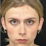 Facial Feminization Before & After Patient #2192