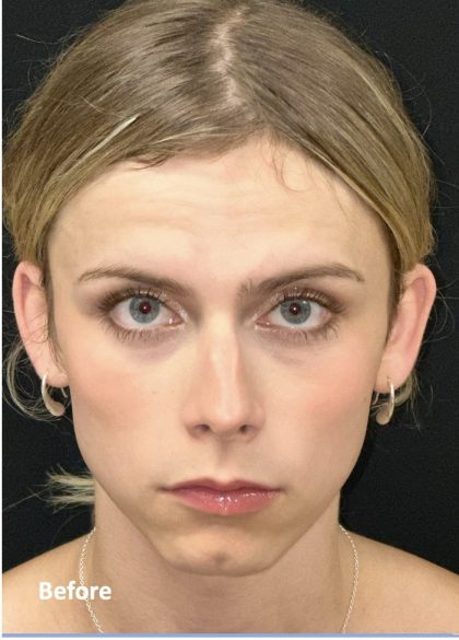 Facial Feminization Before & After Patient #2192