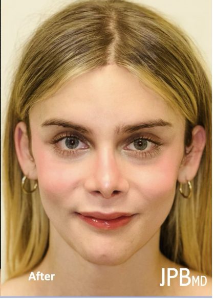 Facial Feminization Before & After Patient #2192