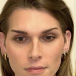 Facial Feminization Before & After Patient #2202