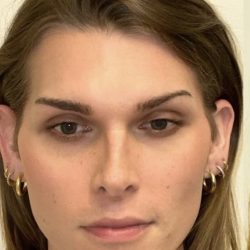Facial Feminization Before & After Patient #2202