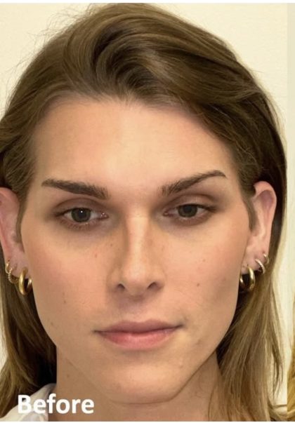 Facial Feminization Before & After Patient #2202