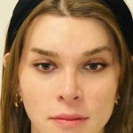 Facial Feminization Before & After Patient #2202