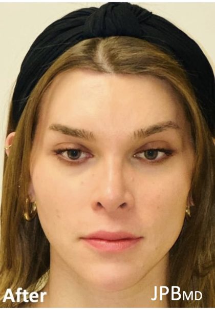 Facial Feminization Before & After Patient #2202