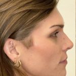 Facial Feminization Before & After Patient #2202