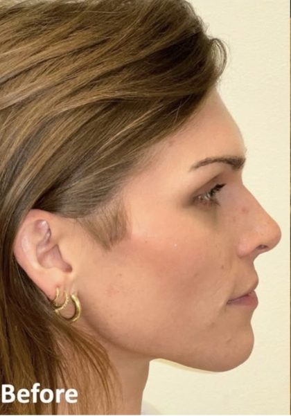 Facial Feminization Before & After Patient #2202
