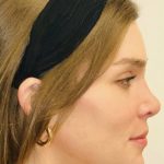 Facial Feminization Before & After Patient #2202
