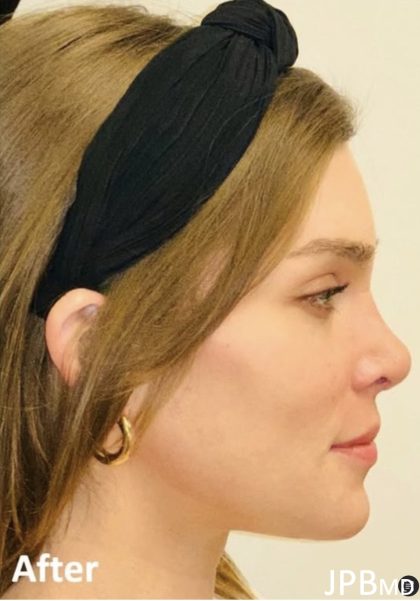 Facial Feminization Before & After Patient #2202