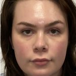 Facial Feminization Before & After Patient #2203