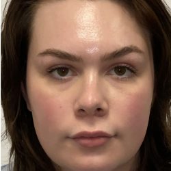 Facial Feminization Before & After Patient #2203