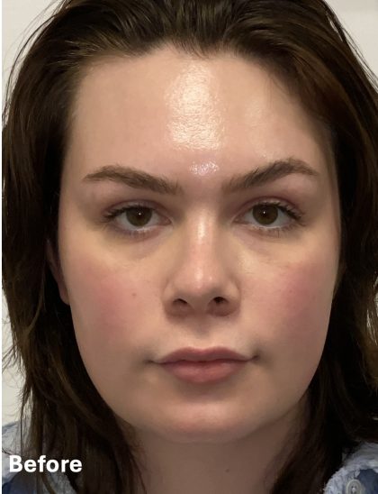 Facial Feminization Before & After Patient #2203