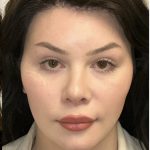 Facial Feminization Before & After Patient #2203