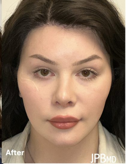 Facial Feminization Before & After Patient #2203