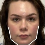 Facial Feminization Before & After Patient #2203