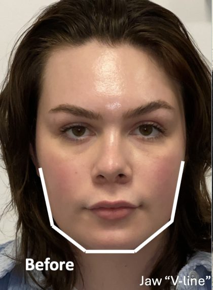 Facial Feminization Before & After Patient #2203