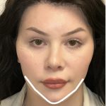 Facial Feminization Before & After Patient #2203