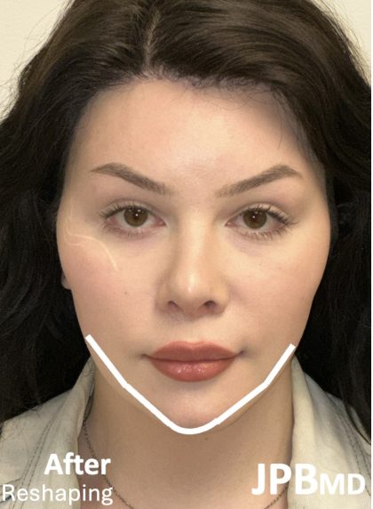 Facial Feminization Before & After Patient #2203