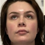 Facial Feminization Before & After Patient #2203