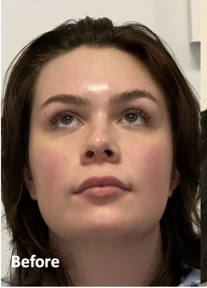 Facial Feminization Before & After Patient #2203