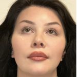 Facial Feminization Before & After Patient #2203