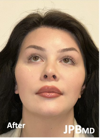 Facial Feminization Before & After Patient #2203