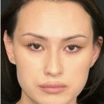Facial Feminization Before & After Patient #2204