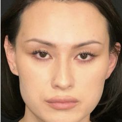 Facial Feminization Before & After Patient #2204