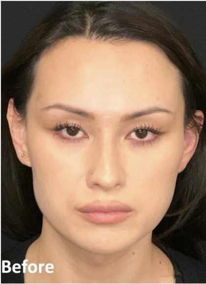 Facial Feminization Before & After Patient #2204