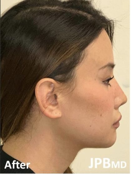 Facial Feminization Before & After Patient #2204
