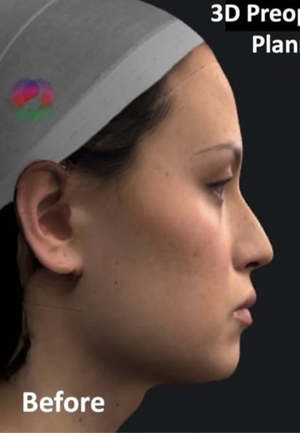 Facial Feminization Before & After Patient #2204