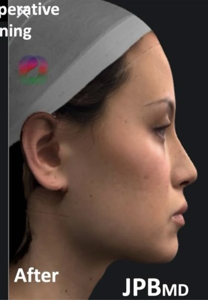 Facial Feminization Before & After Patient #2204